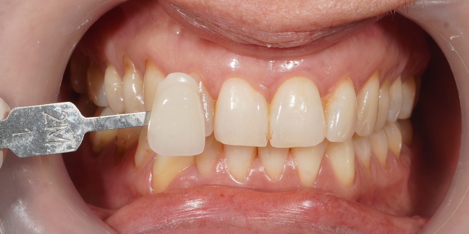 Before: yellowed and stained teeth prior to Picasso Glow laser whitening at Picasso Dental