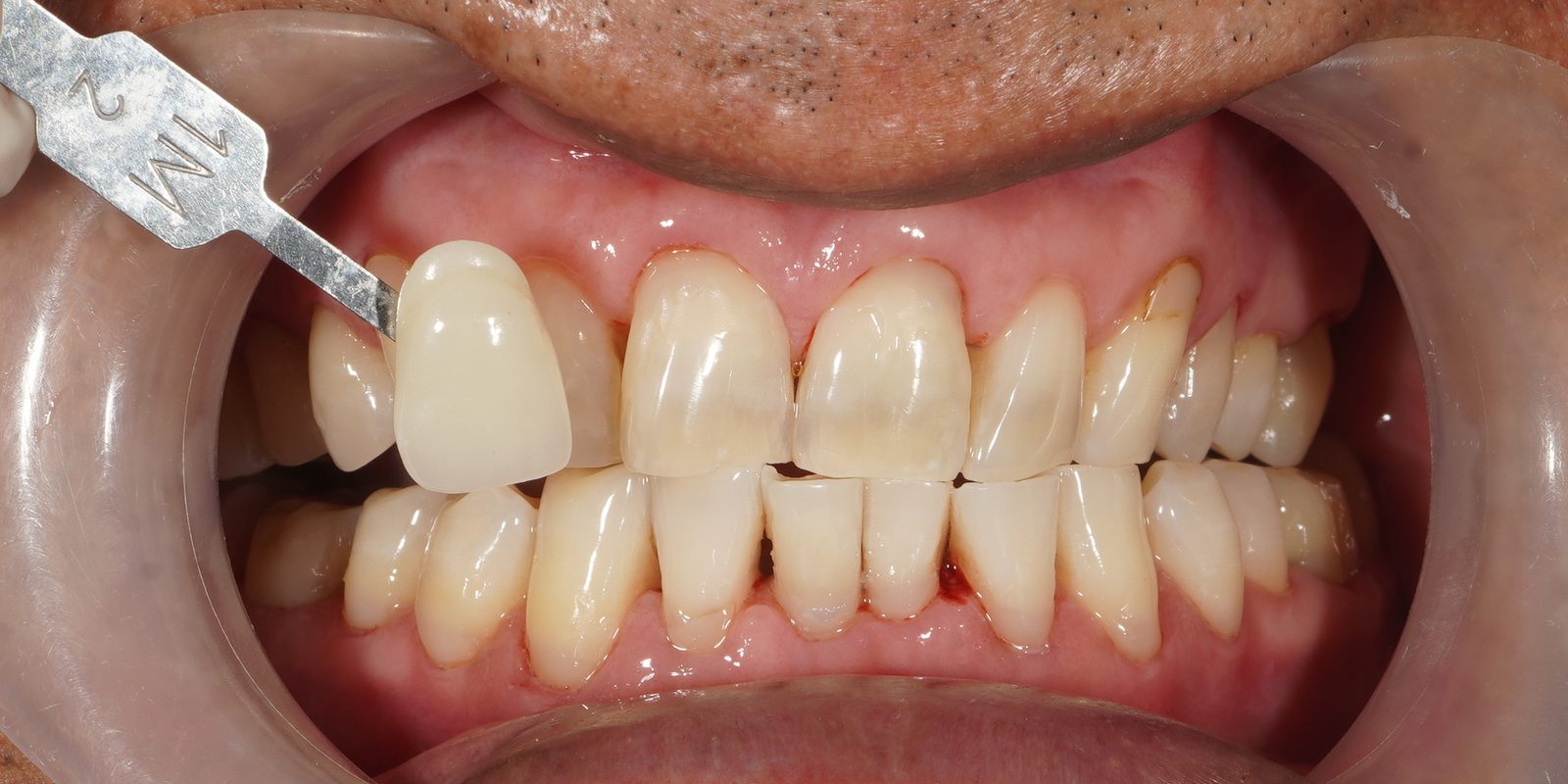 After: dramatically whiter teeth following Picasso Glow laser whitening, Picasso Dental