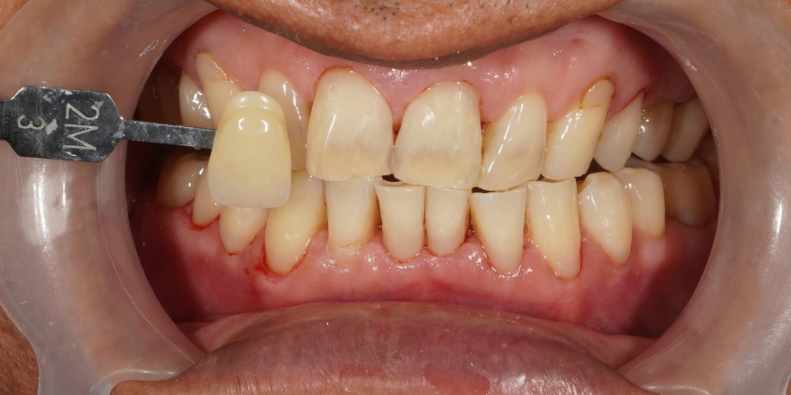 Before: discoloured teeth prior to Picasso Glow laser whitening at Picasso Dental