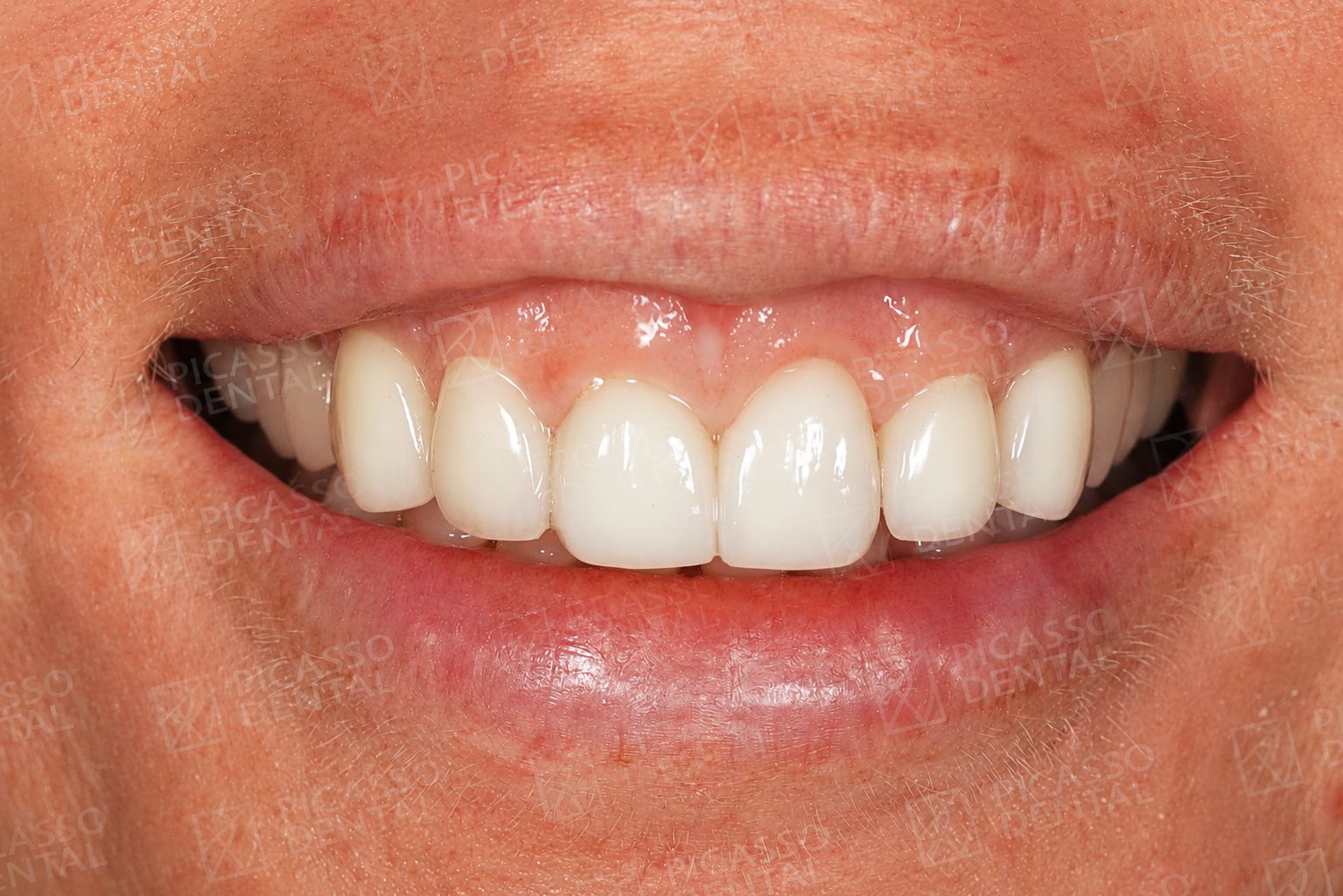 After: 10 Lisi porcelain veneers, upper jaw, Picasso Dental Hanoi Old Quarter