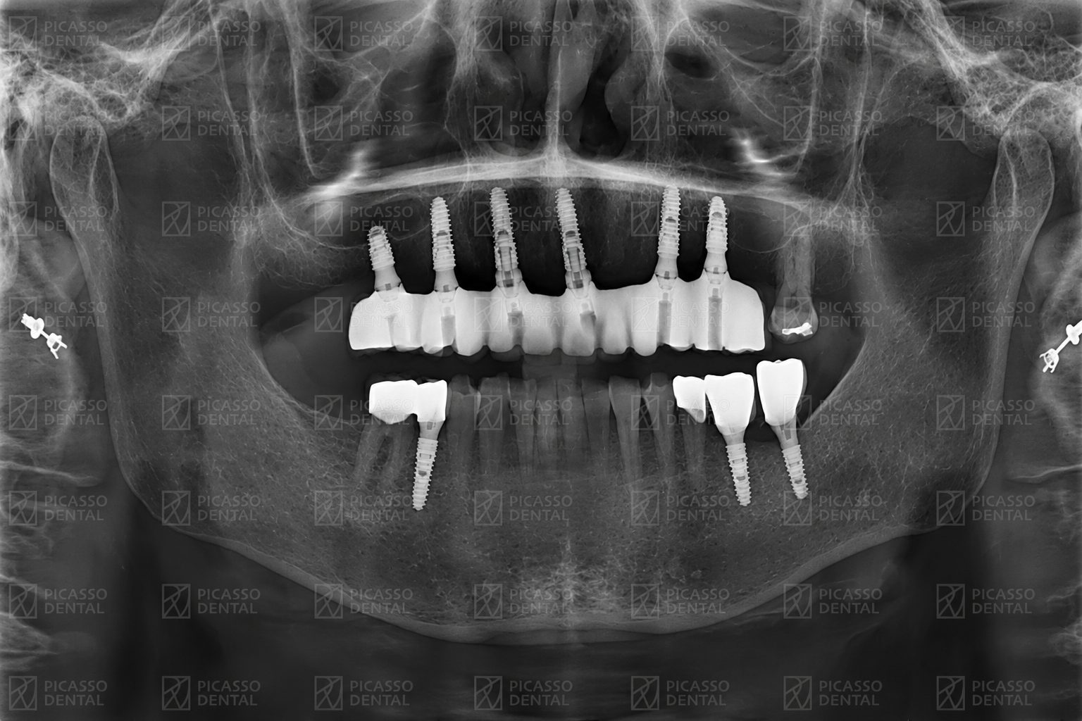 Panoramic CBCT X-ray of the same Picasso Dental patient after All-on-4 implant placement, showing four upper implants and full-arch fixed bridge