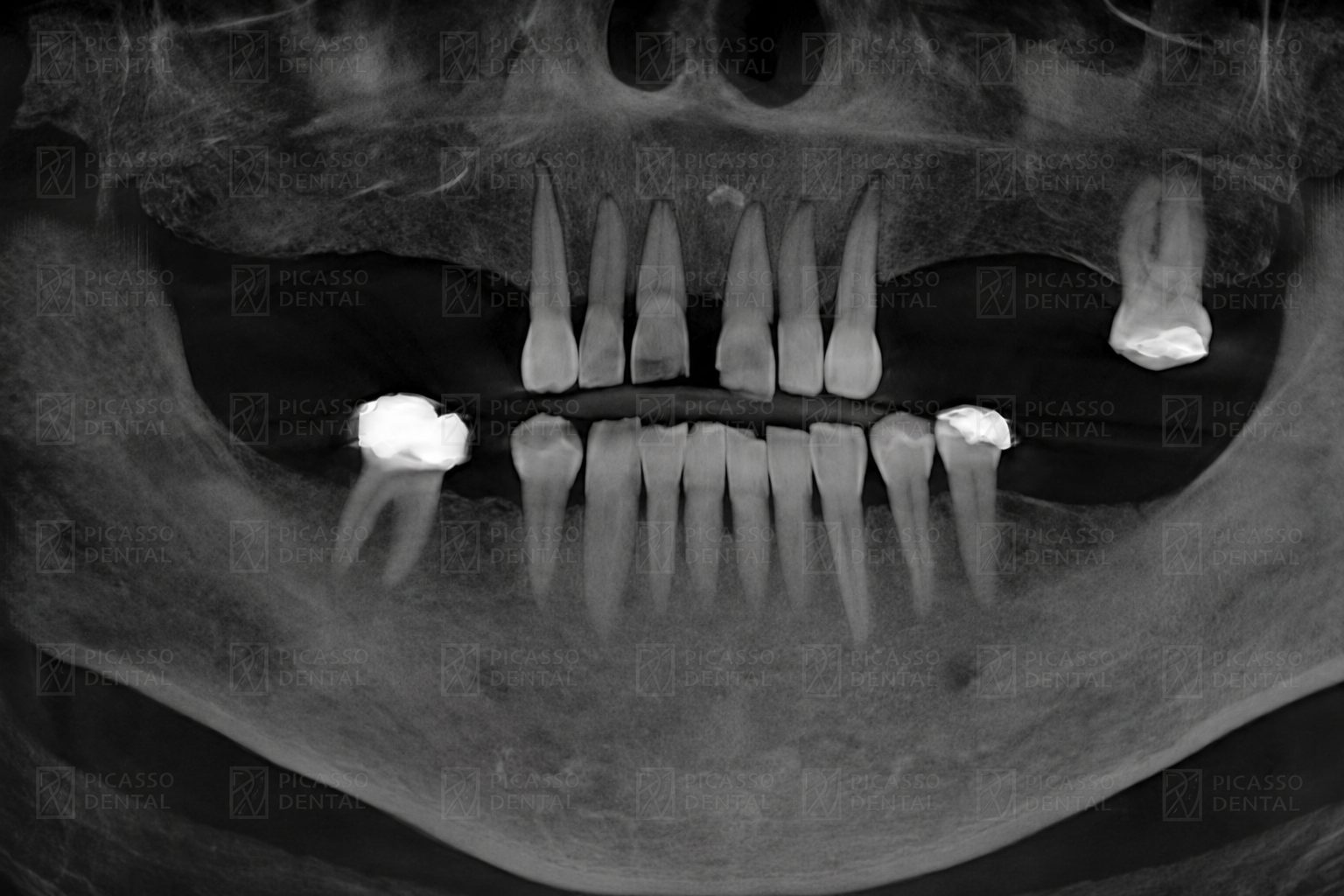 Panoramic CBCT X-ray of a Picasso Dental patient before All-on-4 implant placement, showing failing upper teeth