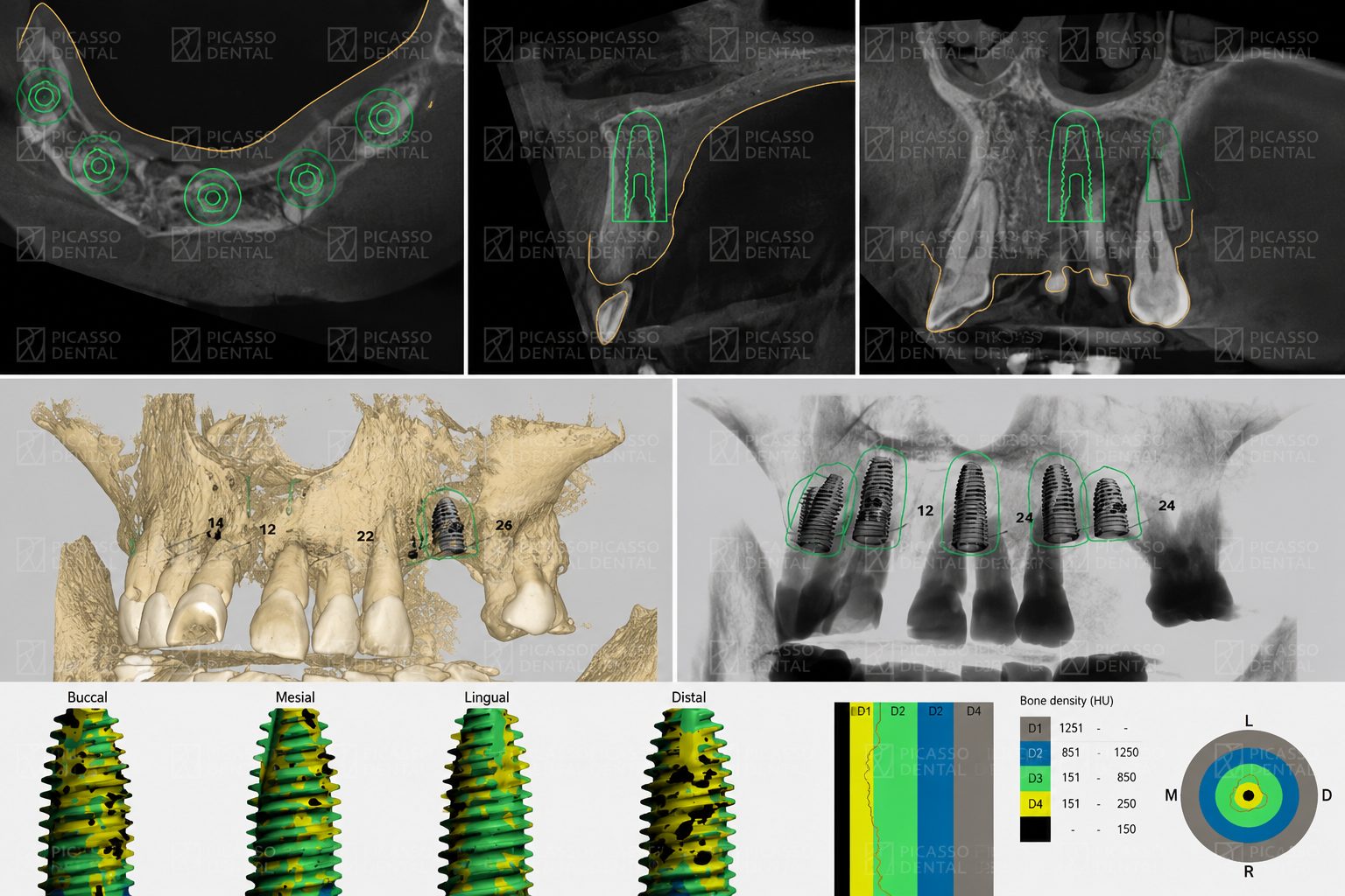 CBCT-guided implant treatment planning at Picasso Dental, showing 3D bone density analysis, surgical guides and digital implant positioning