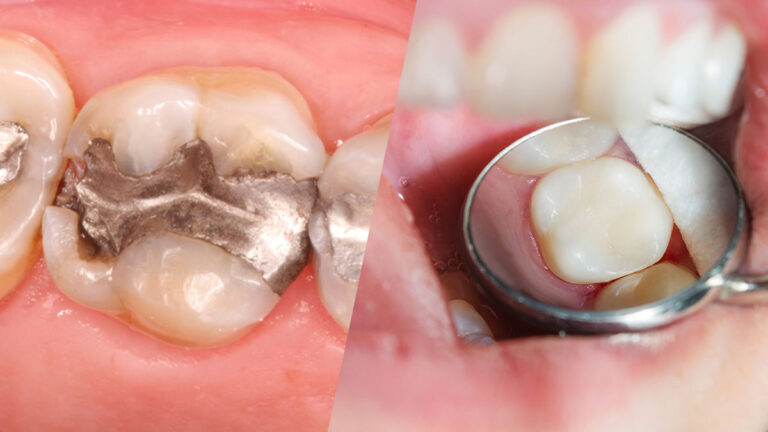 Amalgam vs Composite Fillings