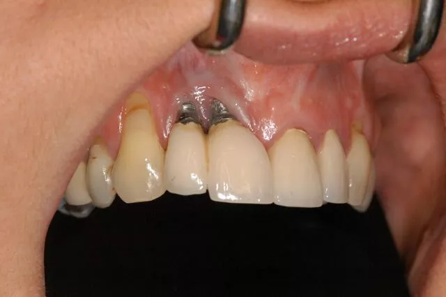 dental implant failure