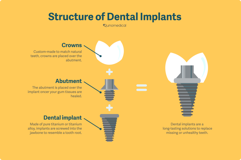 dental implant structure