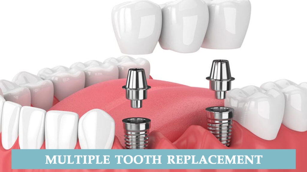 multiple tooth replacement