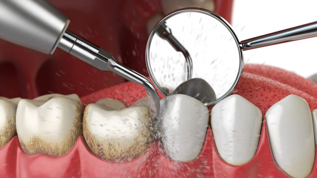 routine dental cleaning