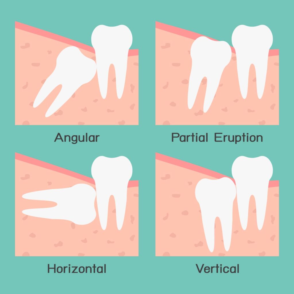 Wisdom teeth are a third set of molars in the back of your mouth. They usually come in between the ages of 17 and 25, and they're spotted on X-rays. Most people have them removed for one of these reasons: They’re impacted. Because they're so far back in your mouth, wisdom teeth may not come in normally. They can be trapped in your jawbone or gums, which can be painful. They come in at the wrong angle. They may press against your other teeth. Your mouth isn’t big enough. Your jaw has no room for an extra set of molars. Wisdom Tooth Extraction - why