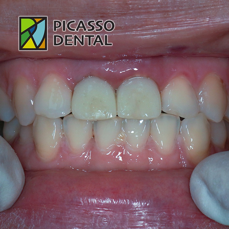 A Beautiful Smile Restored: Dental Implants for a 36-Year-Old Female Patient