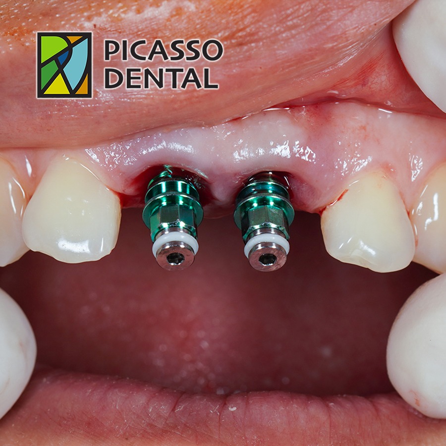 A Beautiful Smile Restored: Dental Implants for a 36-Year-Old Female Patient