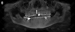 dental implant and lava crown