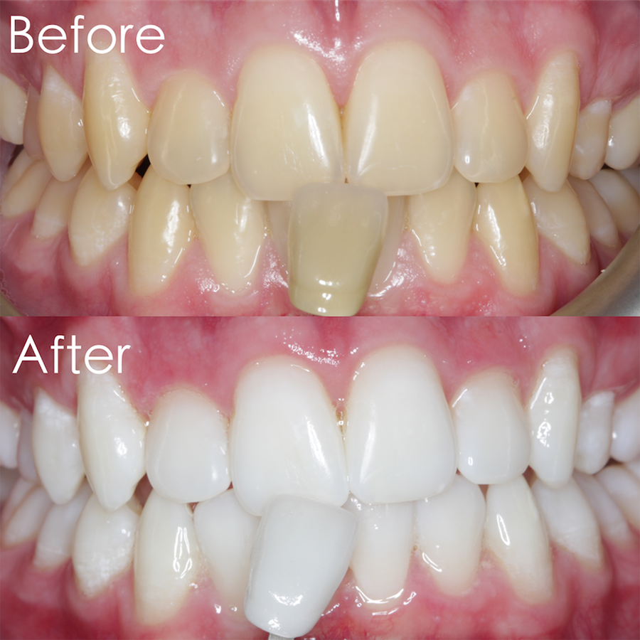 zoom laser whitening before after