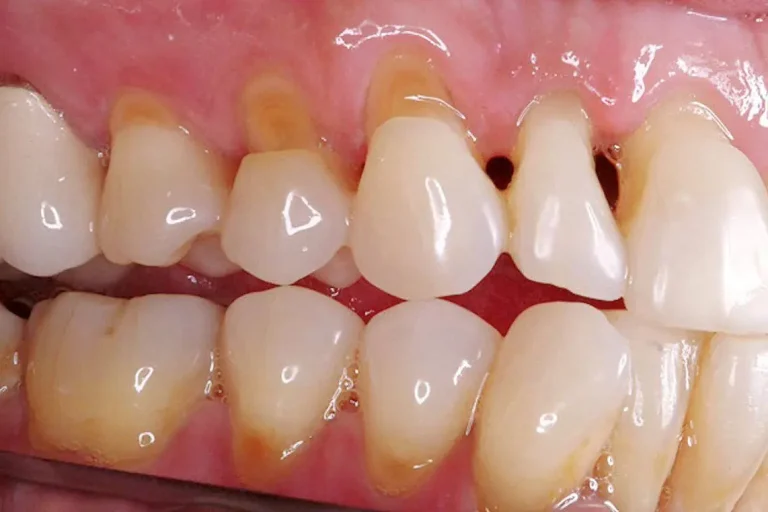 What Causes Tooth Neck Wear