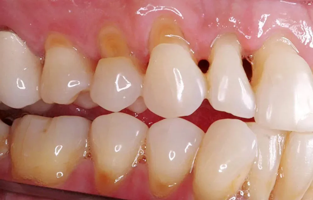 What Causes Tooth Neck Wear What Causes Tooth Neck Wear