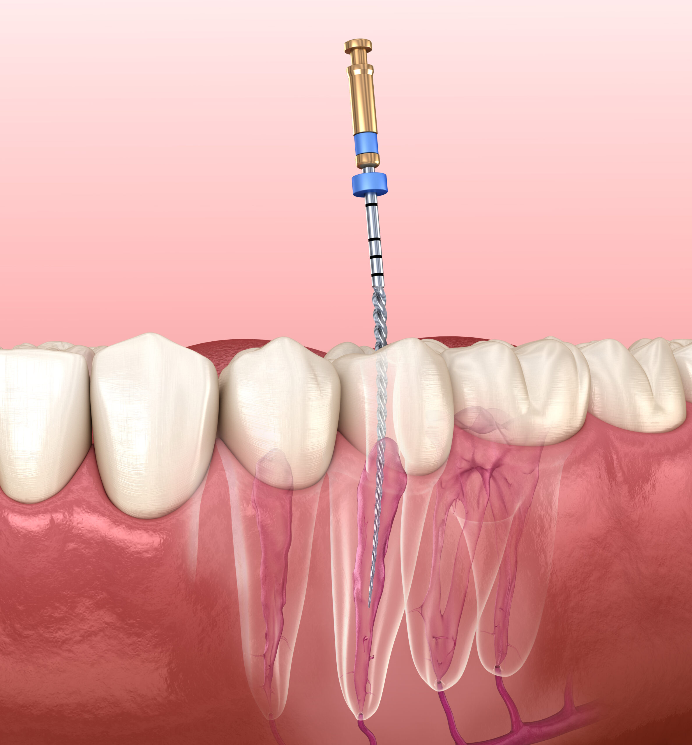 Cost of Root Canal Treatment in Vietnam