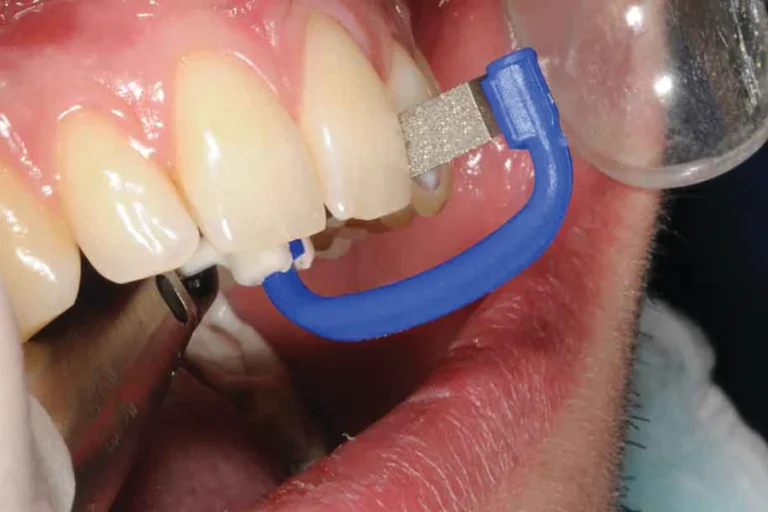 Interproximal Reduction Invisalign