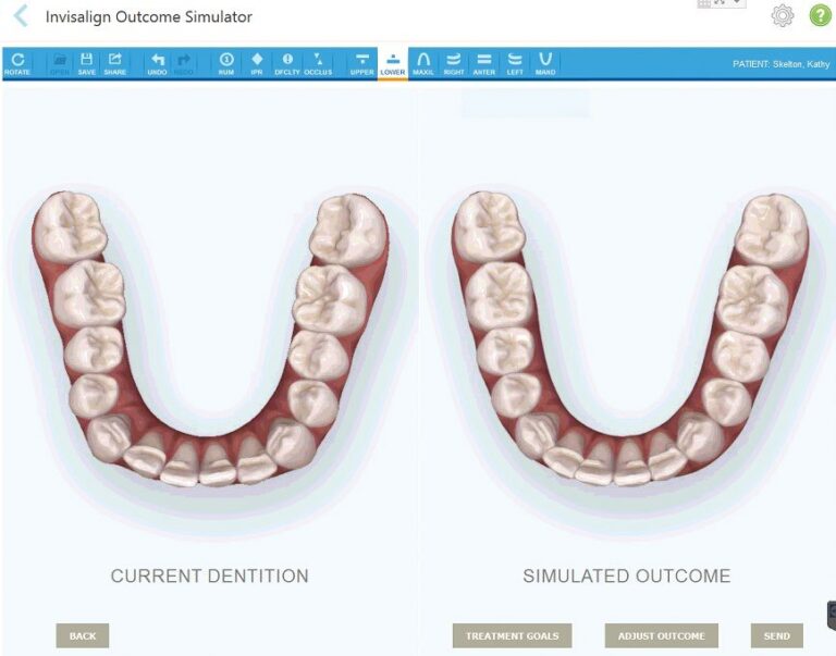 itero Tooth movement