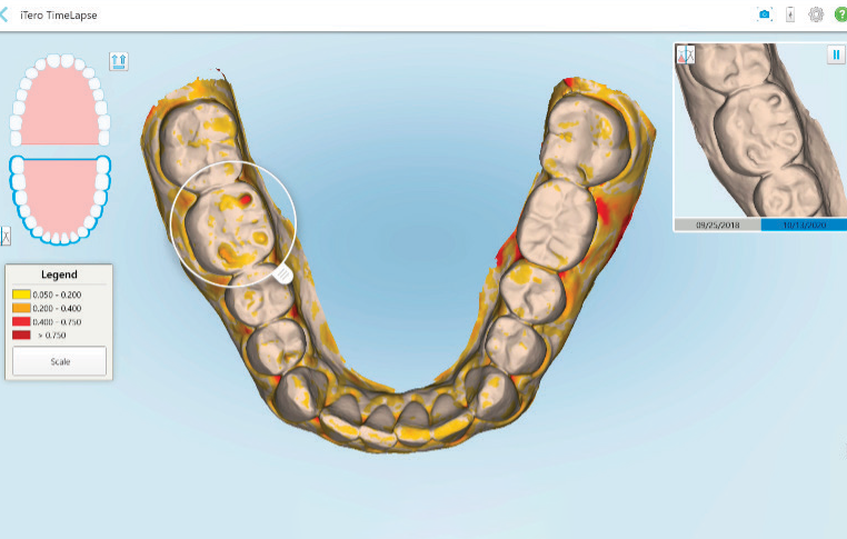 iTero Oral Health Scanner