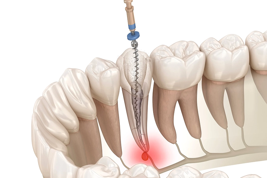 What's the Cost of Root Canal Treatment in Vietnam?