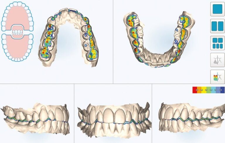 bite analysis