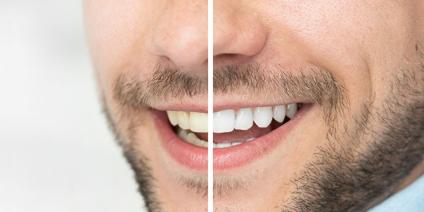 Does teeth whitening damage enamel