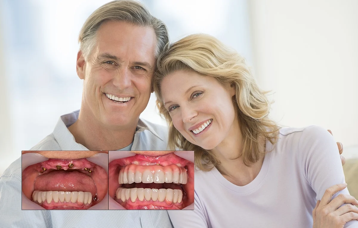 full mouth dental implant cost vietnam