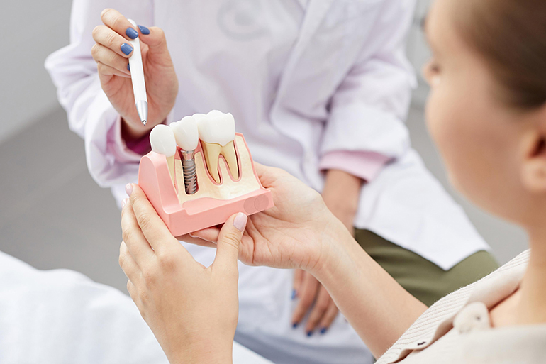 How Long Do Dental Implants Last_images - blyss-dental-implant-l