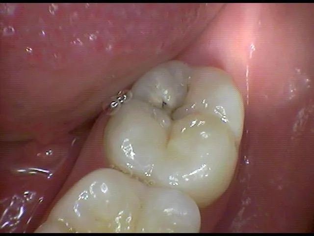 black spot on my crown