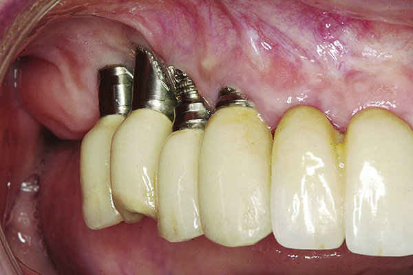 Dental implant bone loss