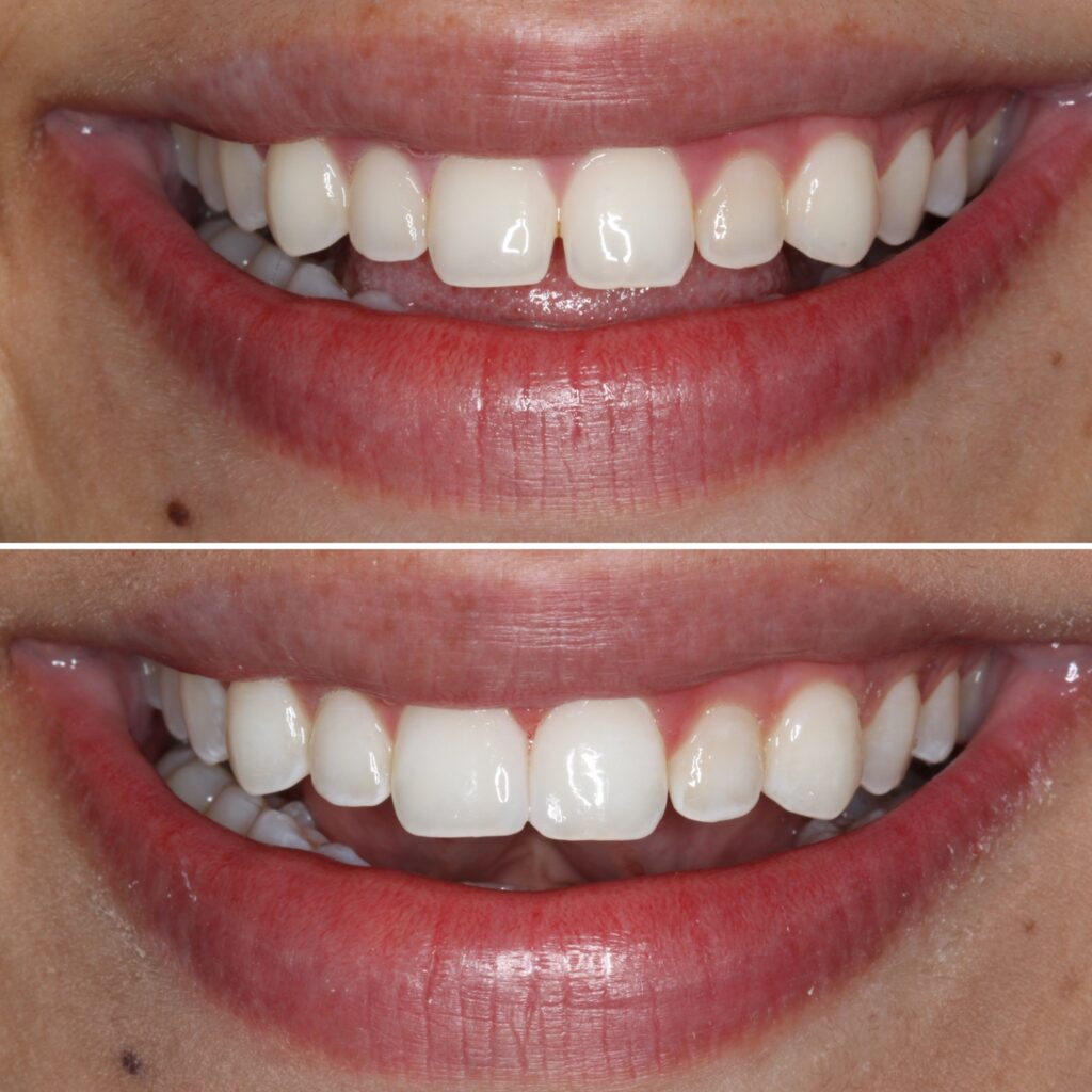 Misaligned & Crowded Teeth- Smile Makeover in Vietnam