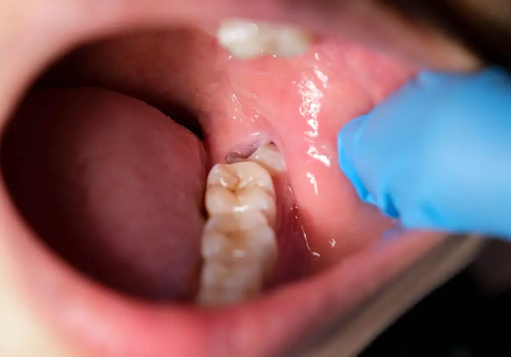 Wisdom tooth removal bleeding