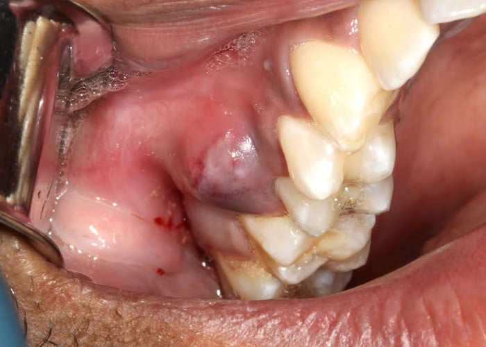 abscess after wisdom tooth removal