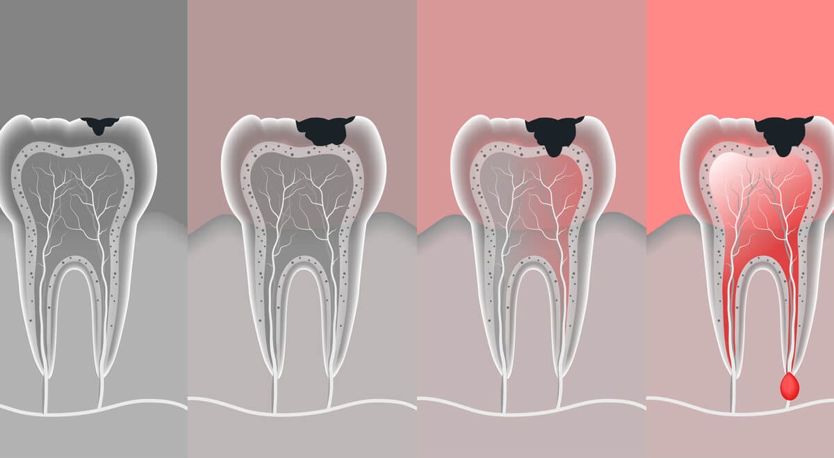 Is root canal treatment painful
