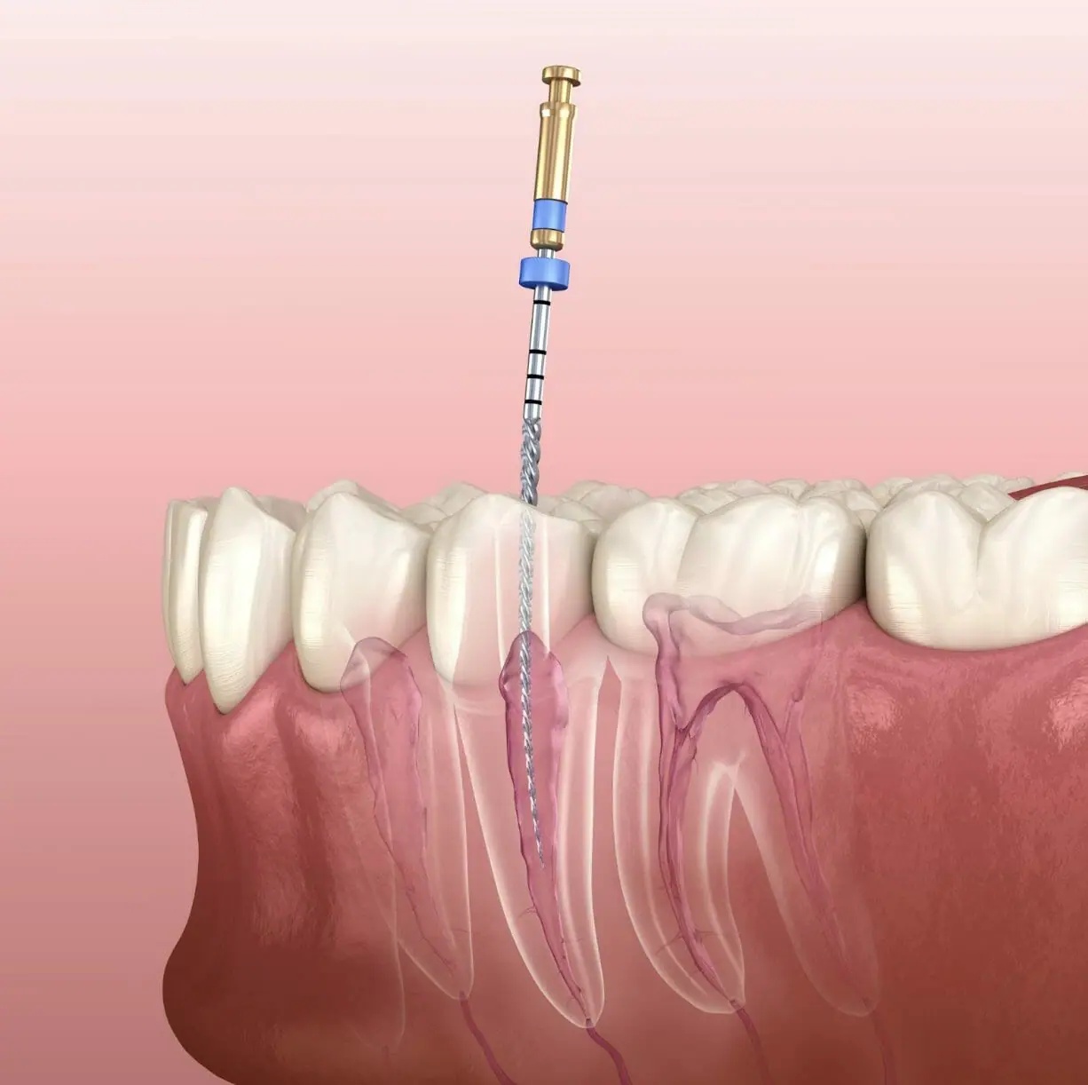 is root canal treatment painful