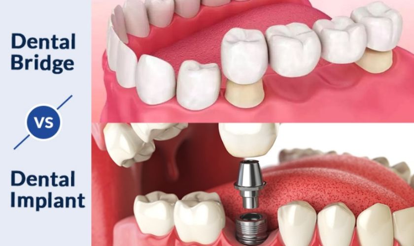 Single Tooth Implants vs. Bridges: Making the Right Choice for Long-Term Oral Health