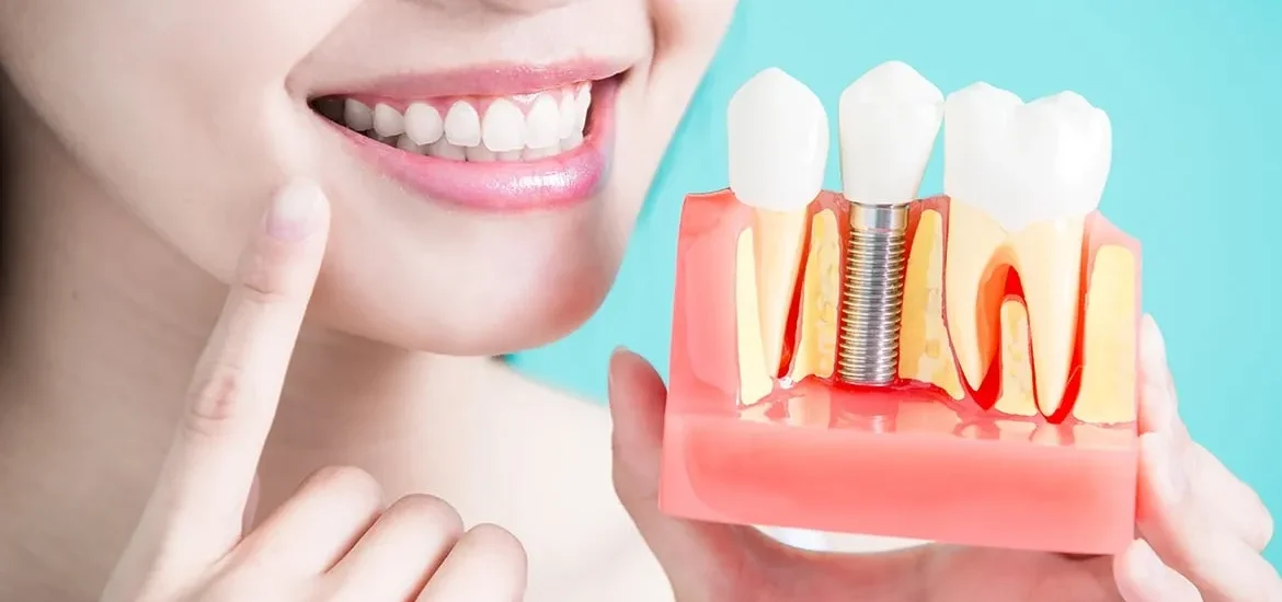 Dental Implants Vietnam