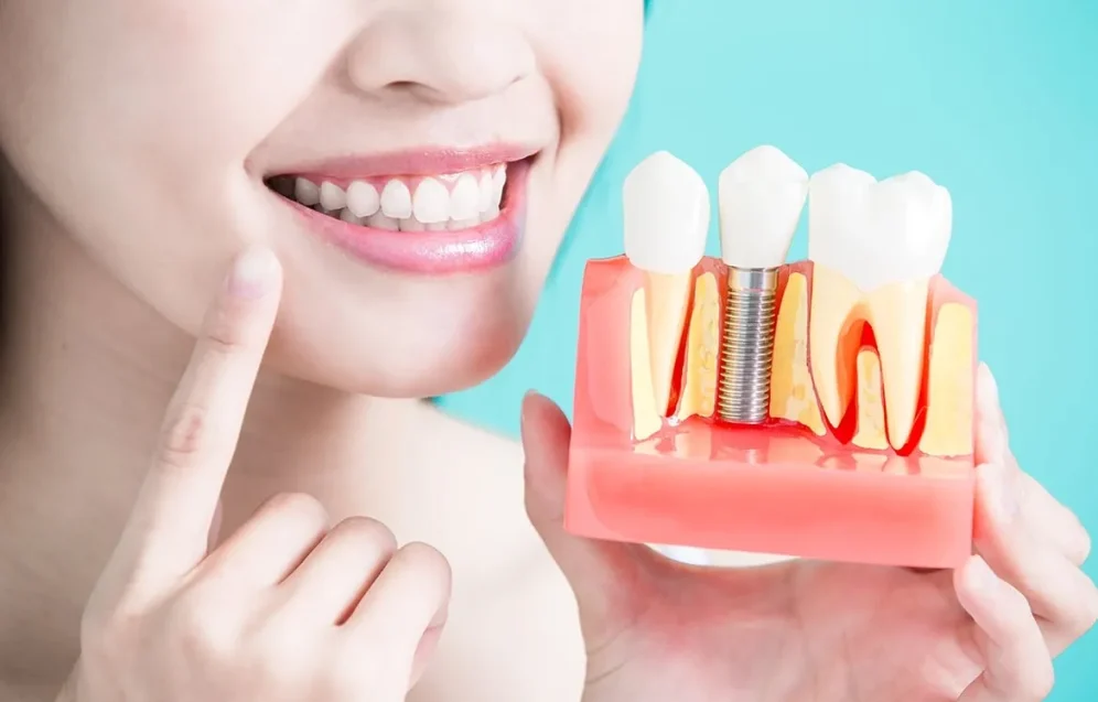 Dental Implants Vietnam