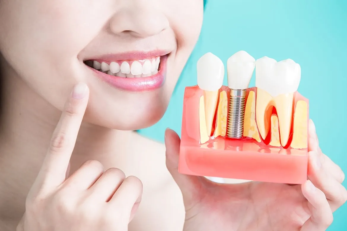 Dental Implants Vietnam