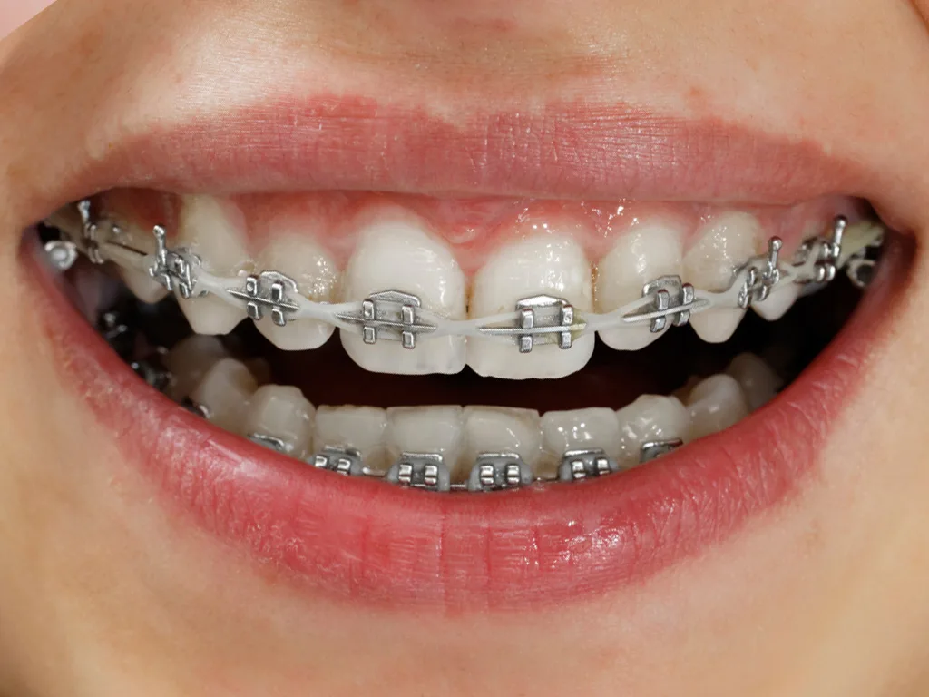 Metal Braces