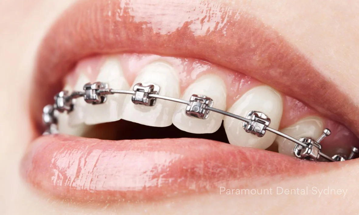Metal Braces