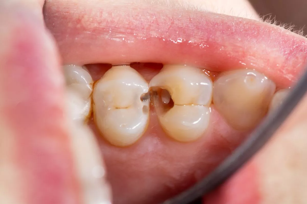 cavity between teeth