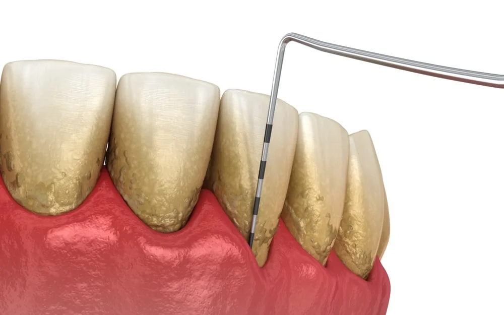 periodontal treatment