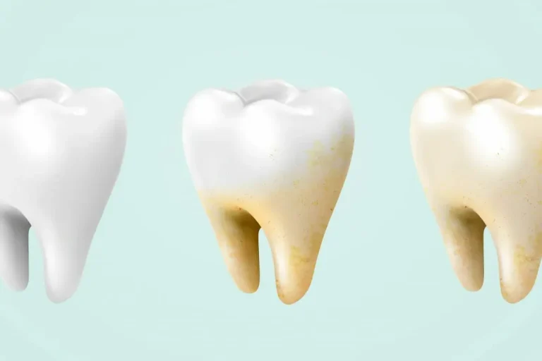 Does laser whitening work on all types of tooth stains