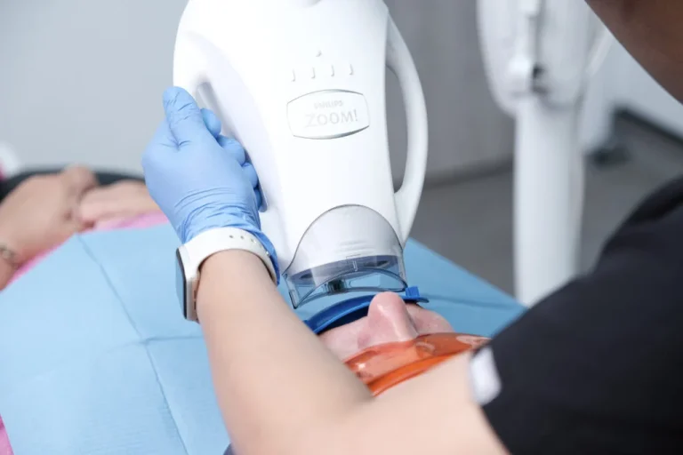 Whitening Process Work at Picasso Dental Clinic Hanoi