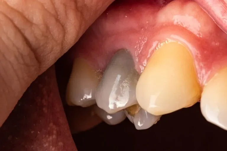 Will the tooth be dead after a root canal