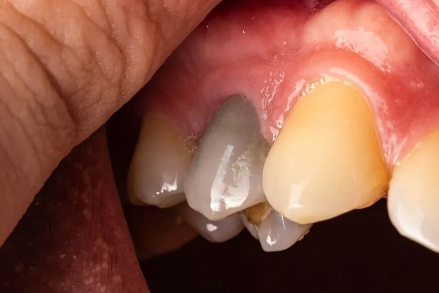 Will the tooth be dead after a root canal