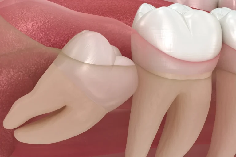 all four wisdom teeth removed at once