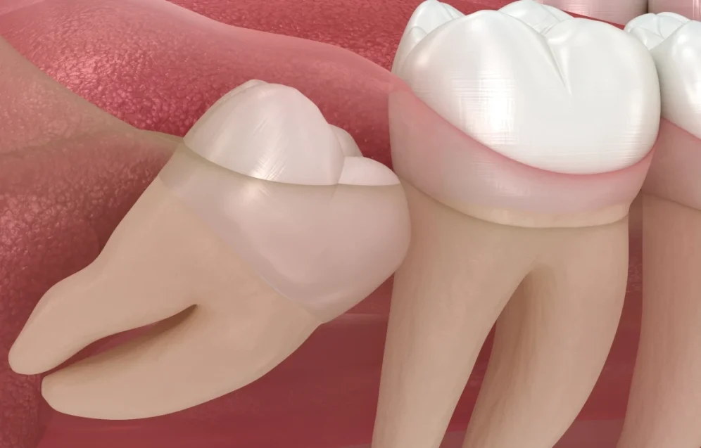 all four wisdom teeth removed at once all four wisdom teeth removed at once