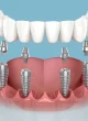 All-on-6 Dental Implants Cost All-on-6 Dental Implants Cost